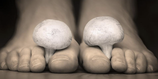 Tips Ampuh Mengatasi Penyakit Kulit Jamur Agar Tidak Kambuh Lagi